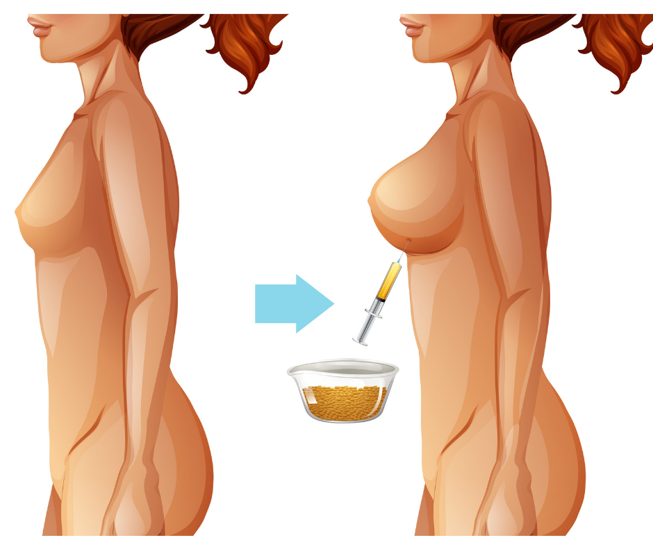 Liposuction with Fat Transfer: Don't waste your fat!