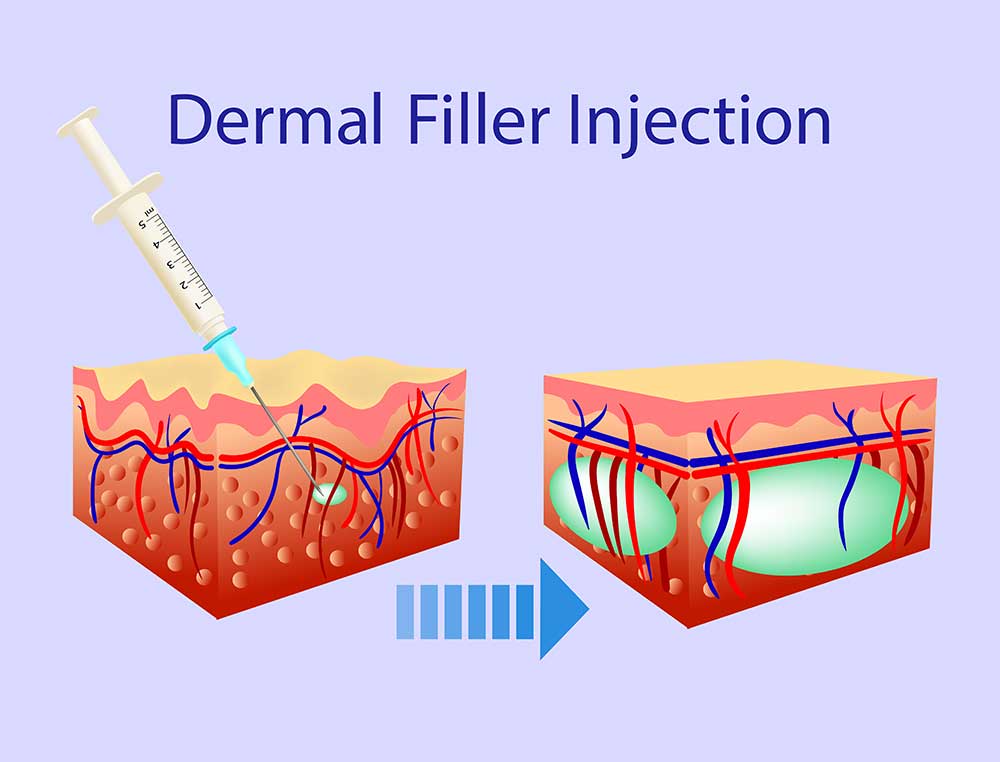 Dermal Filler