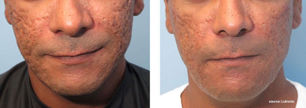 Acne Scar Removal Treatments