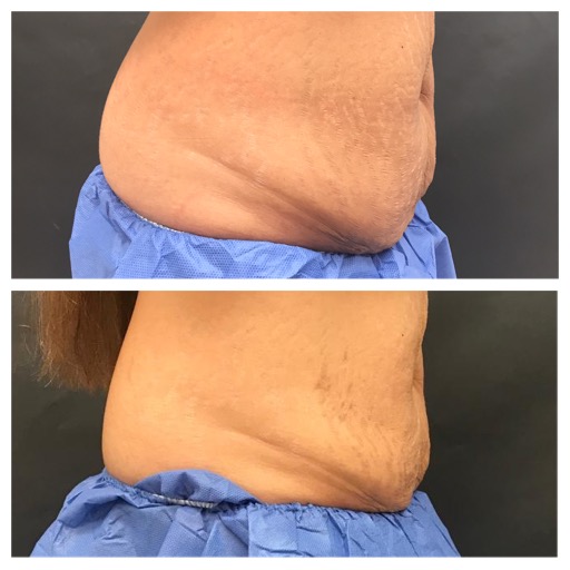 The Skinny on Non-Invasive Fat Reduction: The Case for an a la Carte  Approach to Body Contouring - Practical Dermatology