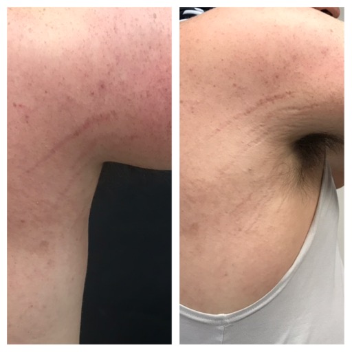 Stretch Mark Treatment Helps to Fade and Eliminate — DermaEnvy Skincare