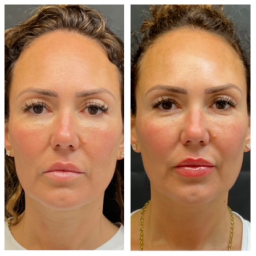 Thread Lift: The Non- Invasive Face- Lift