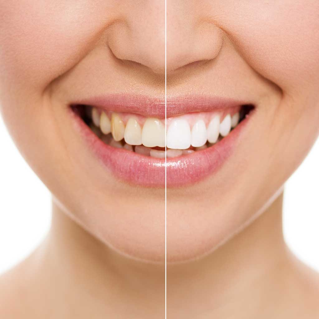 Laser-Teeth-Whitening