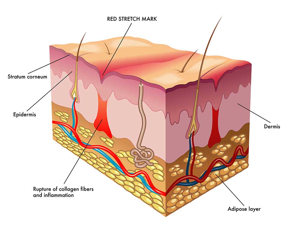 What Are Stretch Marks? - Copperstate OB/GYN