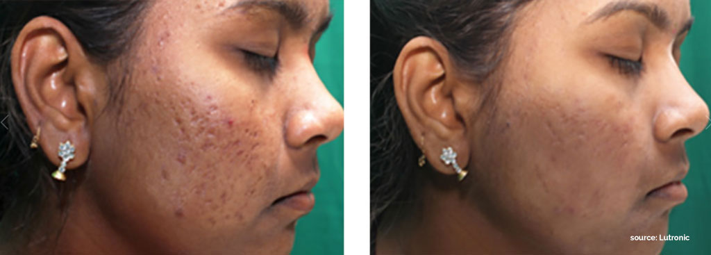 Acne scar reduction