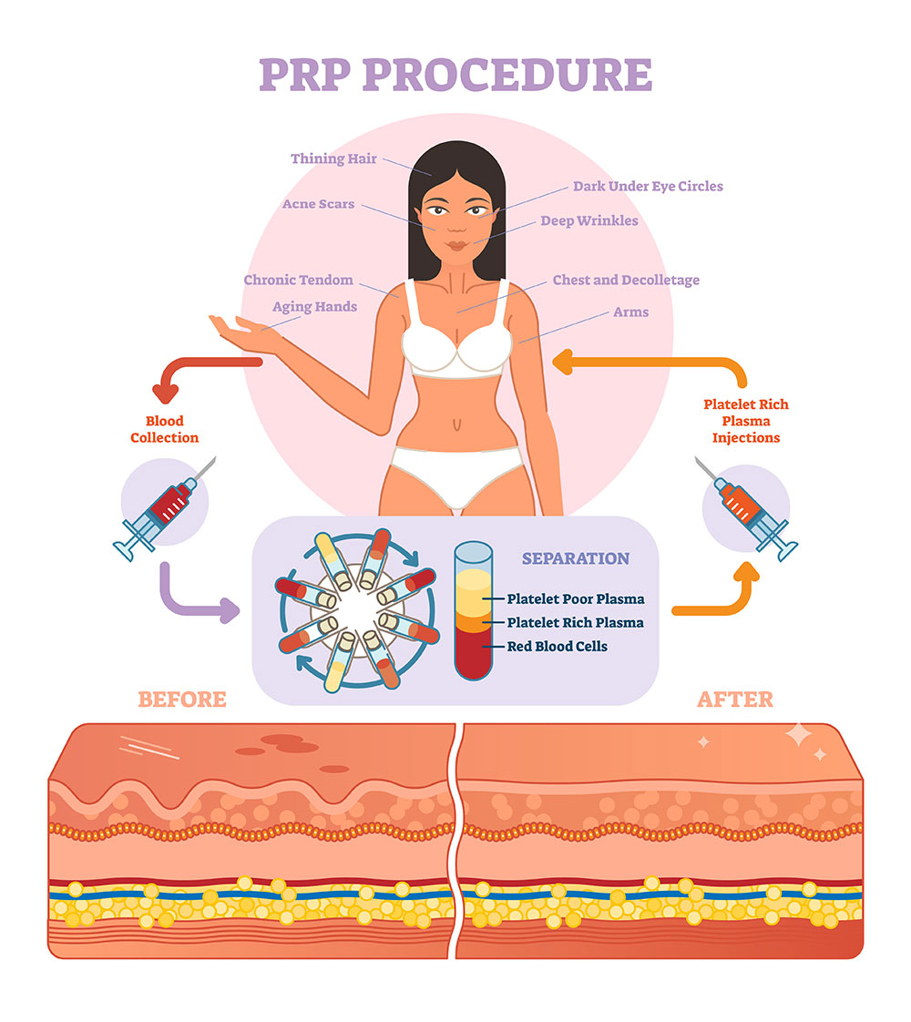 PRP_Procedure