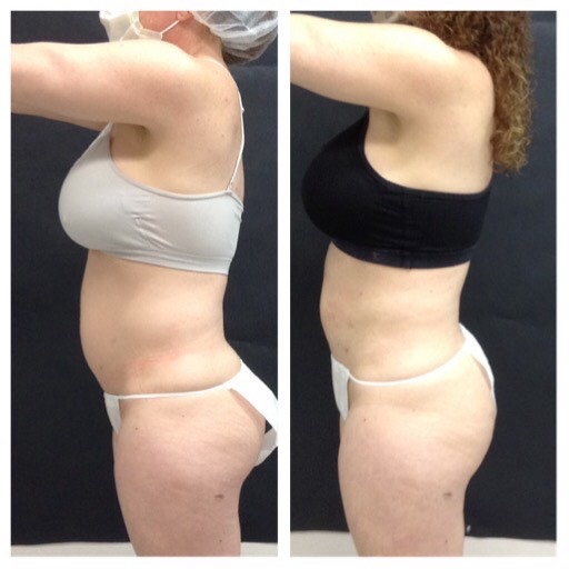 Xero Lipo Body Sculpting - Reshape your body - The Harrogate Clinic