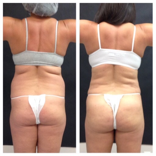 Body Sculpting Before & After Gallery