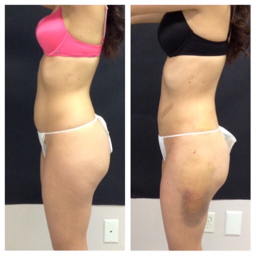 Body Sculpting Treatments That Work - Revivify Medical Spa