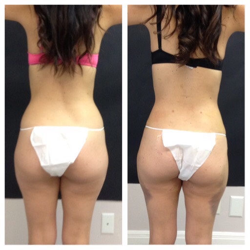 Body Sculpting Treatments That Work - Revivify Medical Spa