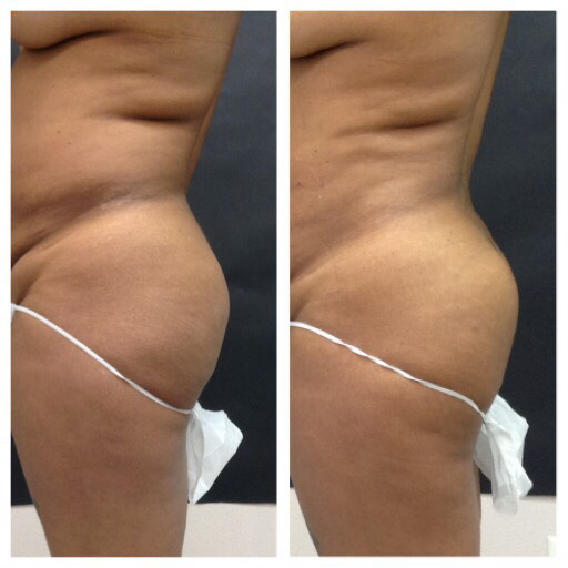 Top 10 BeautiFill Questions Answered - Laser Liposuction