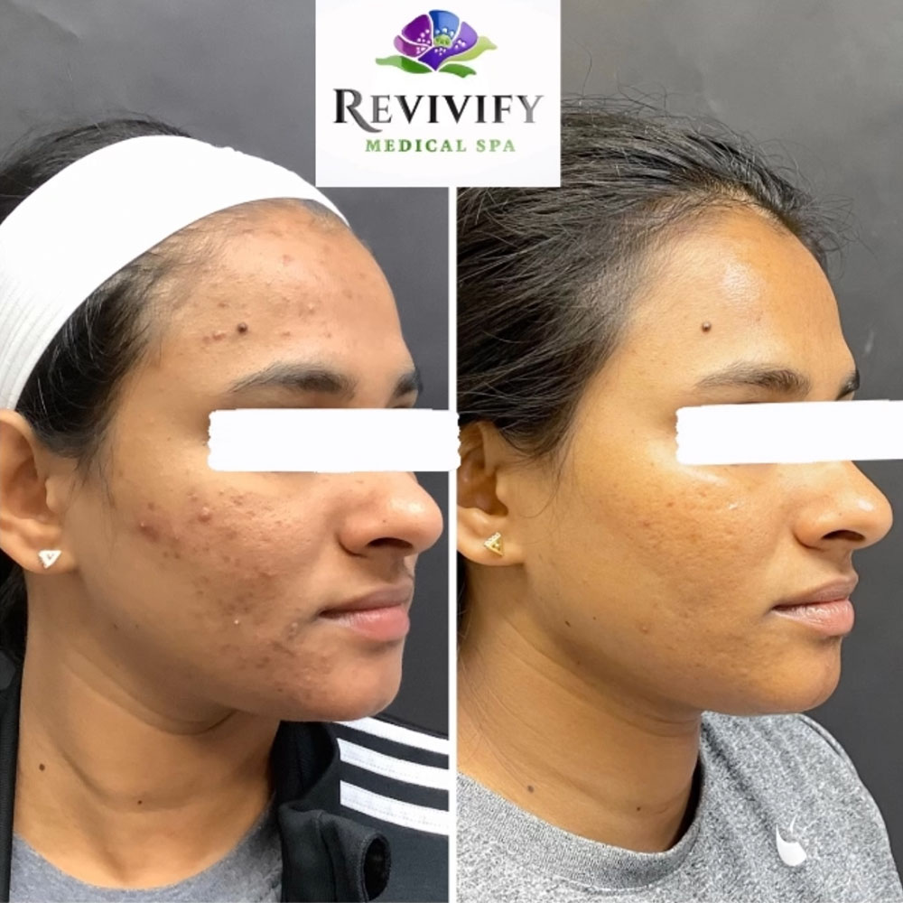 VI Peel Chemical Peel Revivify Medical Spa