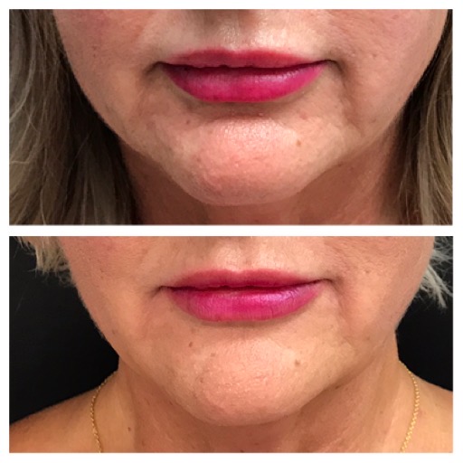 Dermal fillers
