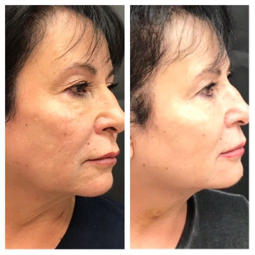 Dermal fillers