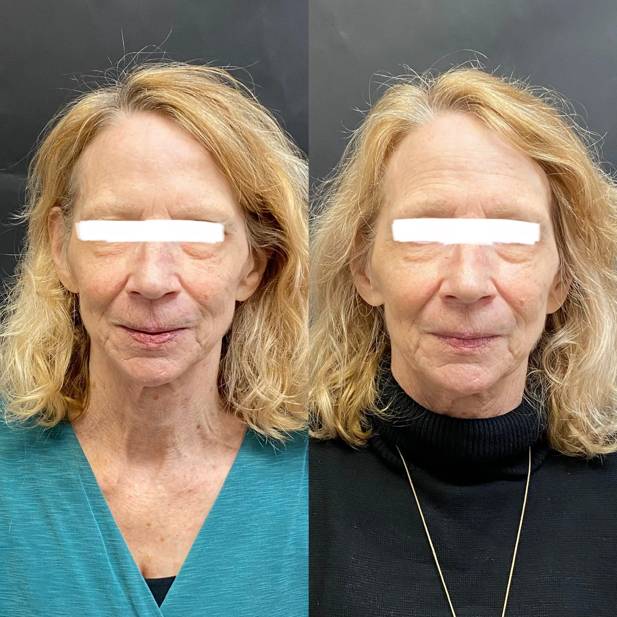 IPL face treatment