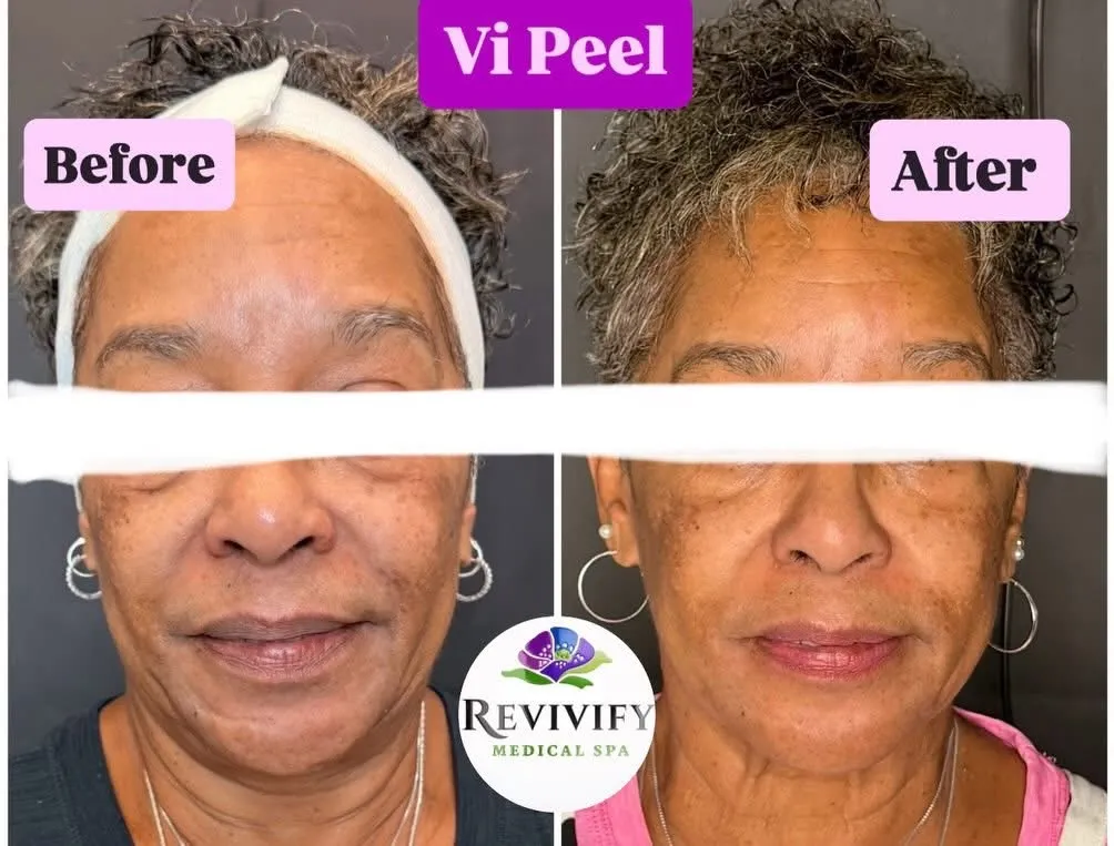 VI Peel
