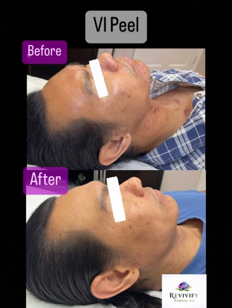 VI Peel