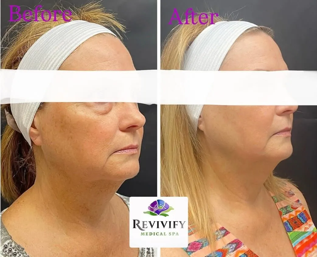 chrome-laser-treatment-for-face-neck