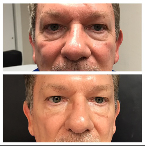 Dermal fillers